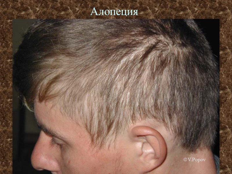 Алопеция г V.Popov